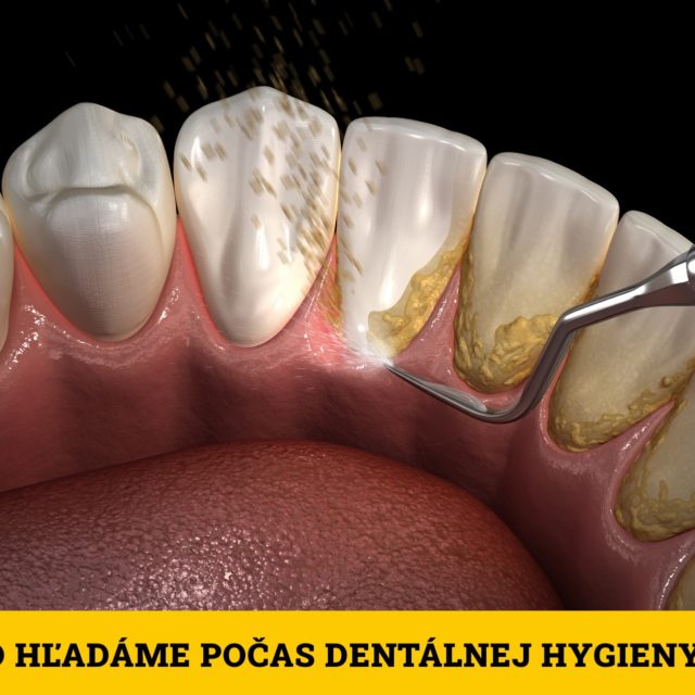 Čo hľadáme počas dentálnej hygieny? 