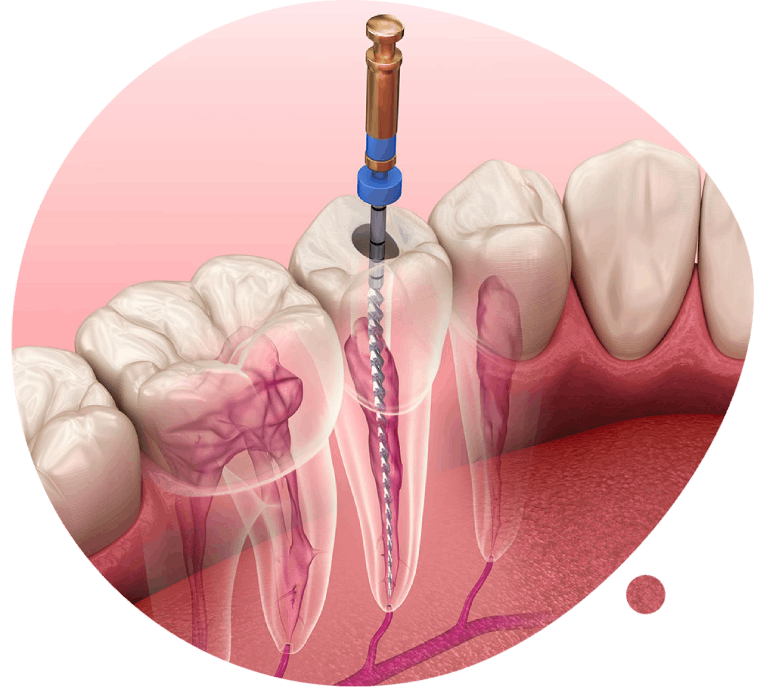 https://kerodent.sk/wp-content/uploads/2023/11/endodoncia.png